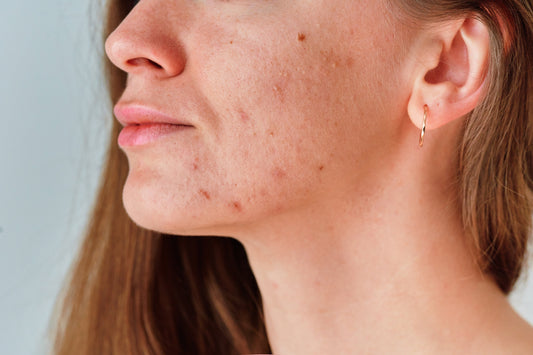 acne prone skin