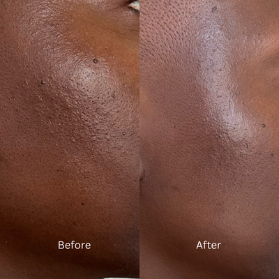 Before and after comparison of skin texture on a person's neck.